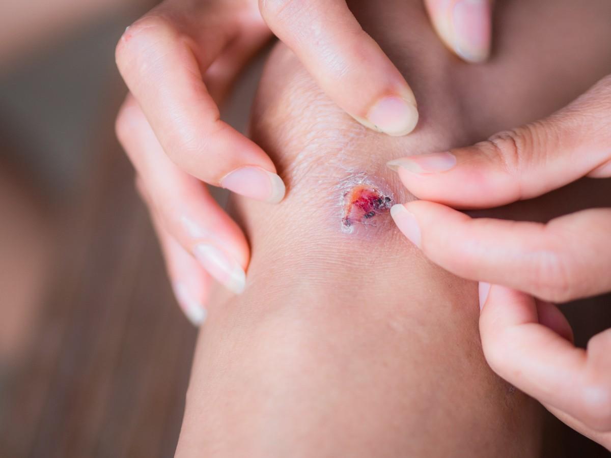 causes of wart