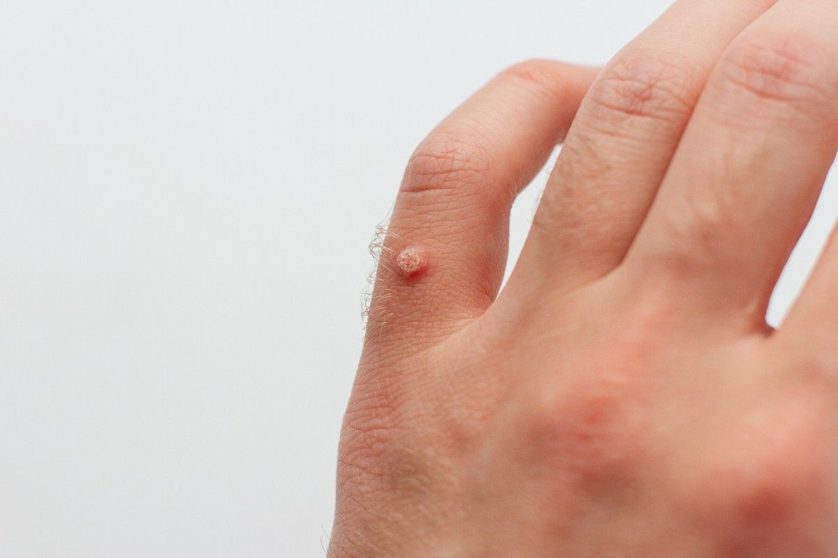 wart removal